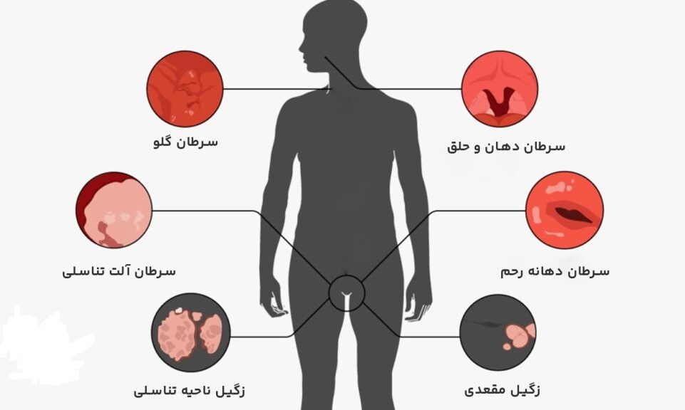 ویروس HPV