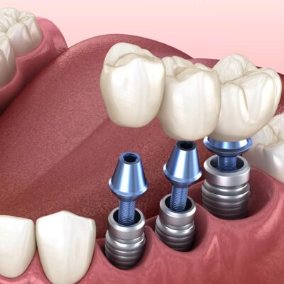 implant-protez-scaled